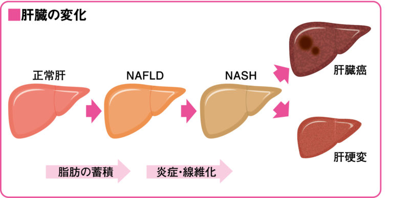 グレード 3 の脂肪肝疾患の原因は何ですか?